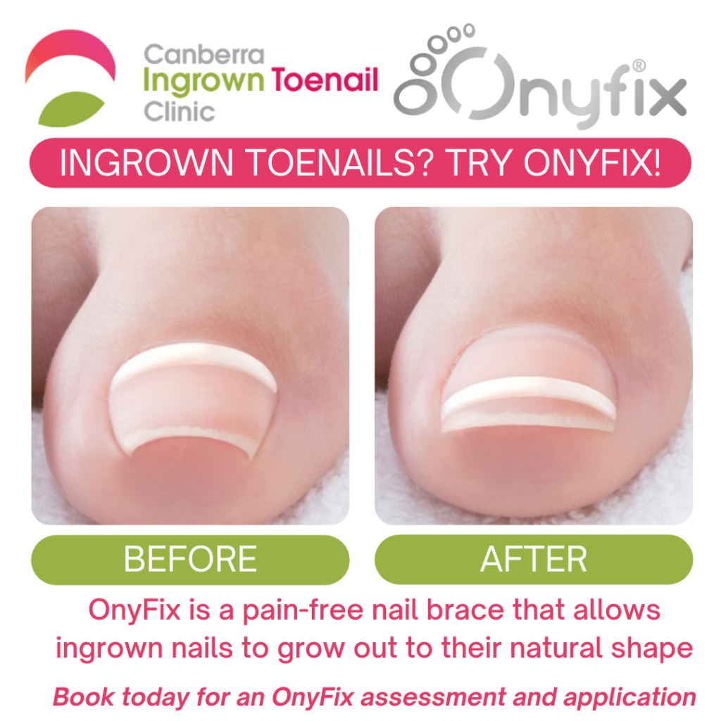 Canberra Ingrown Toenail Clinic Onyfix Nail Bracing Ingrown Toenail Care